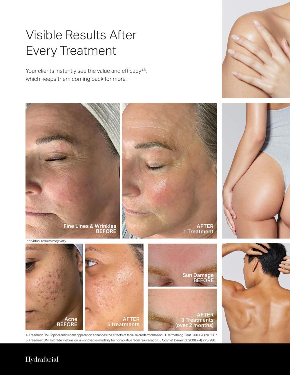 HydraFacial Before and After Results